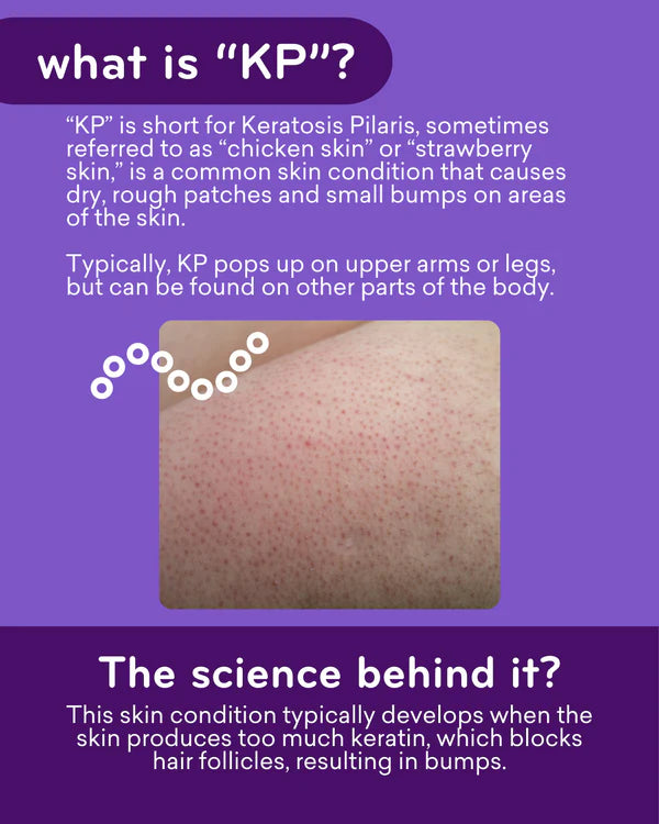 Amlactin KP Bumps Be Gone Hydrating Cream, Moisturizing Cream For Rough and Bumpy Dry Skin, 3 Oz Tube